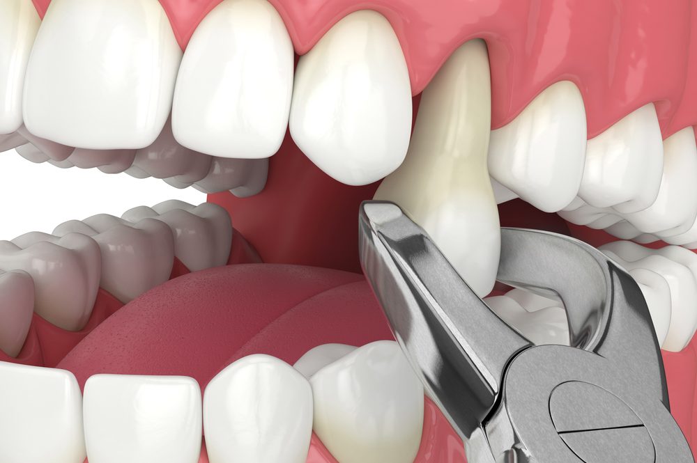 3d,Render,Of,Lower,Jaw,With,Tooth,Extracted,By,Dental